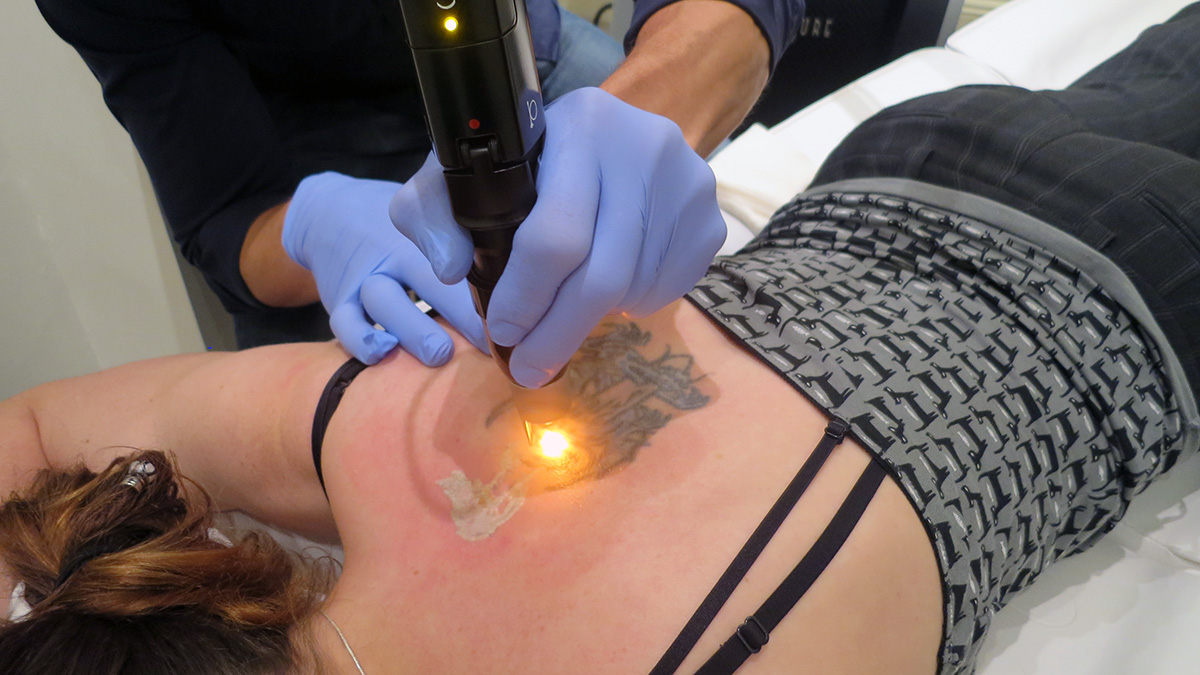 Top Tips To Care For Your Skin After Tattoo Removal