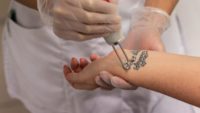 5 Things You Need To Know Before Having A Tattoo Removed