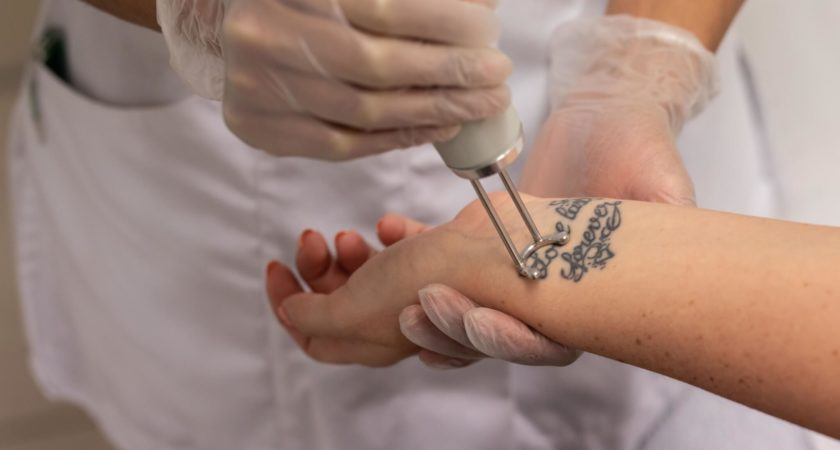 5 Things You Need To Know Before Having A Tattoo Removed